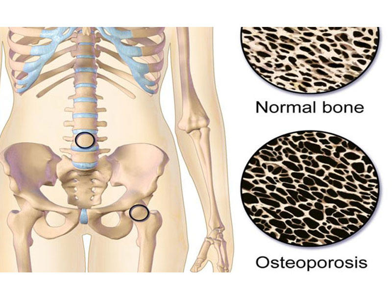 Sümük kütləsinin azalması - OSTEOPOROZ. Səbəblər, simptomlar, müalicə