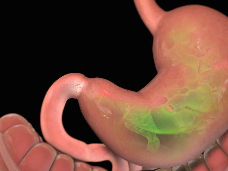 Qida borusunun peptik yarası