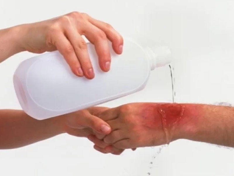 Yanıqlar zamanı ilk tibbi yardım