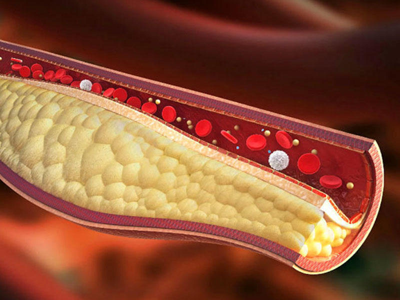 Gün ərzində 1 stəkan bu içkidən istifadə etmək qan damarlarındakı sklerozun təmizlənməsinə səbəb olur