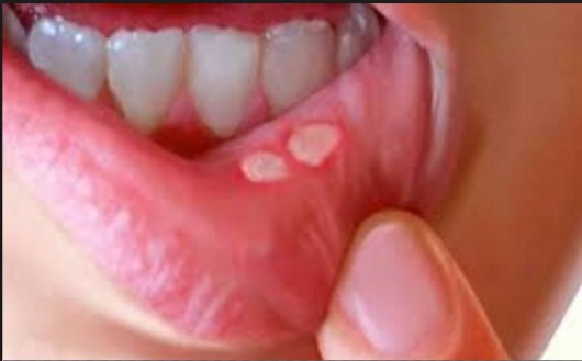 Bir neçə dəqiqədə ağız boşluğunda olan stomatitdən dərmansız xilas olun!