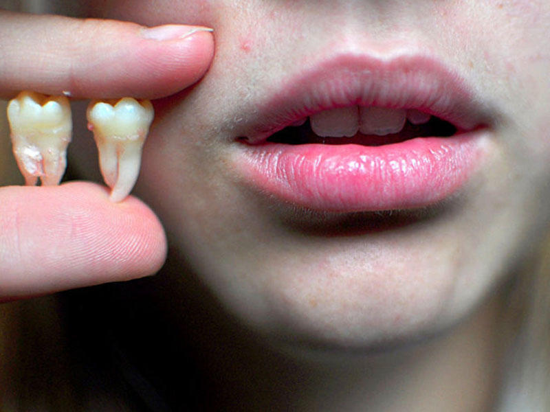 Şok: Korona diş tökülməsinə səbəb olur - Araşdırma