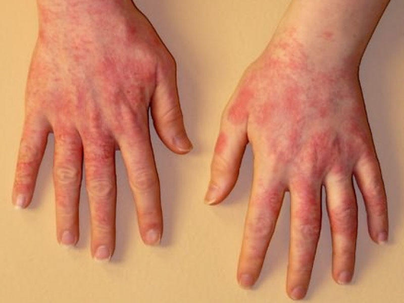 Spirtdən aşırı dərəcədə istifadə allergik dəri xəstəliklərinə səbəb ola bilər