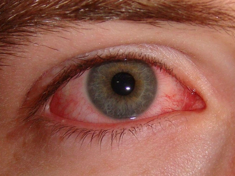 İnfeksiyalara yoluxma nəticəsində gözlərdə müxtəlif xəstəliklər yarana bilər