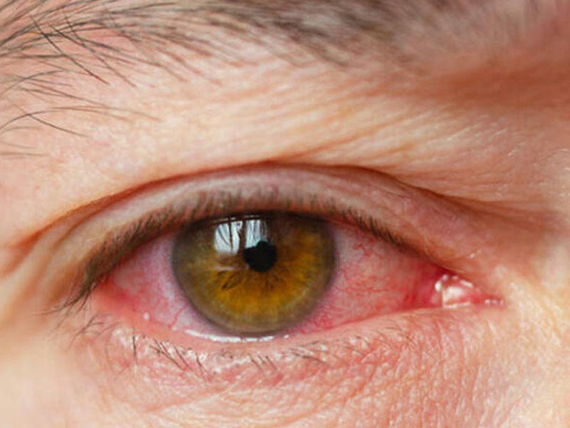 Bu göz şikayətləri koronavirusun əlamətidir?