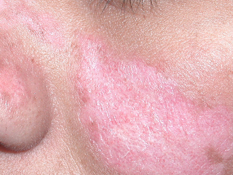 Sistem qırmızı qurd eşənəyinin kliniki mənzərəsi