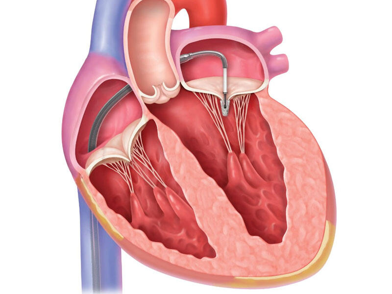 Aortal stenoz