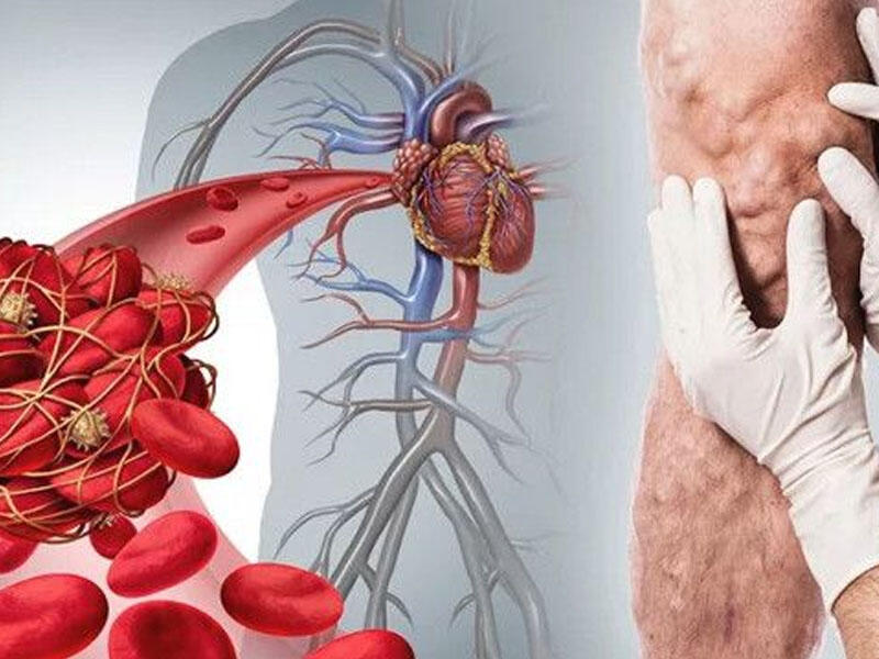 30 dərəcə istidə tromb yaranma riski artır - Kardioloqdan MƏSLƏHƏT