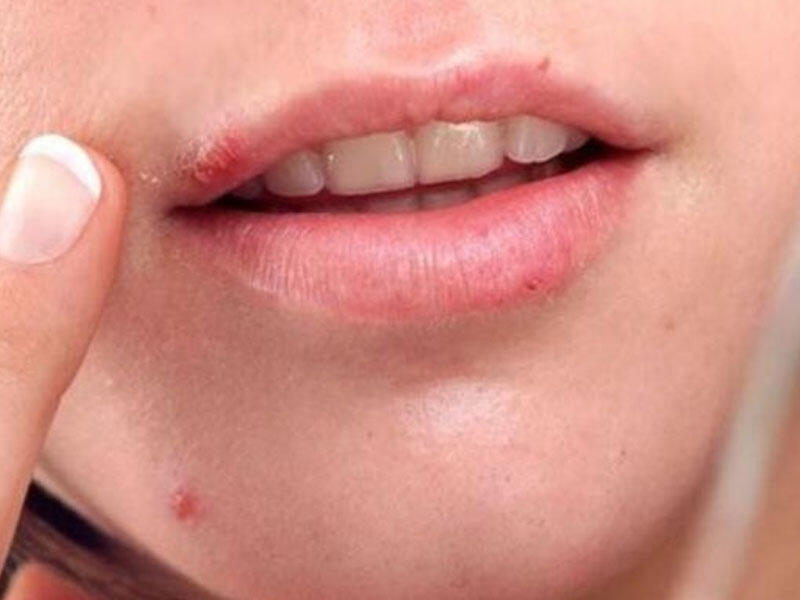 Uçuğa qarşı yaxşı təsir edir