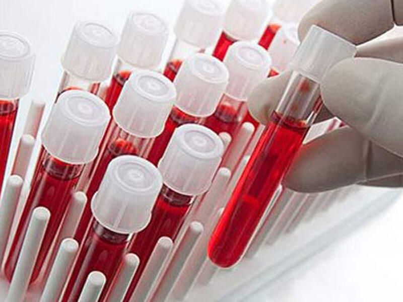 Alzheimer xəstəliyinə tutulma riski qan qrupu ilə bağlı ola bilər