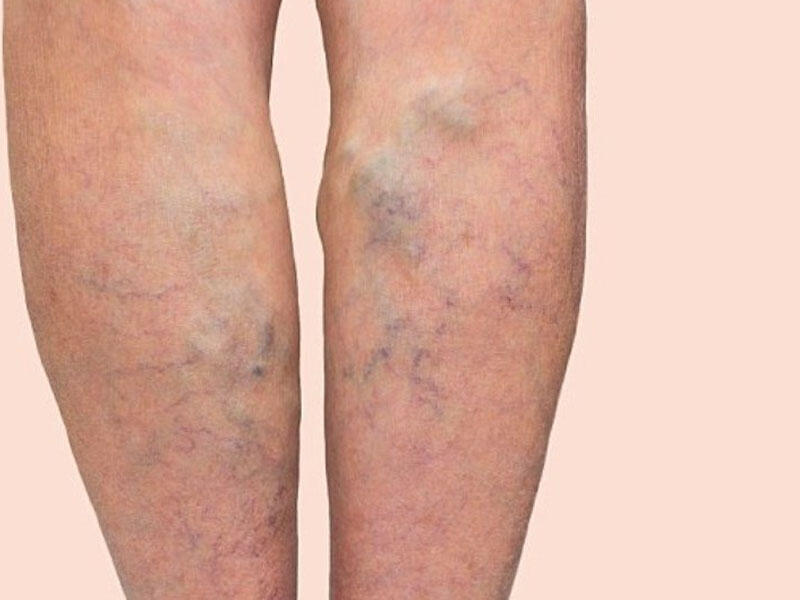 Varikoz xəstəliyi: ayaqlarınızın gözəlliyini itirməyin