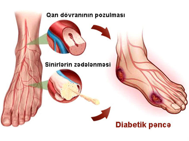 Diabetik pəncə
