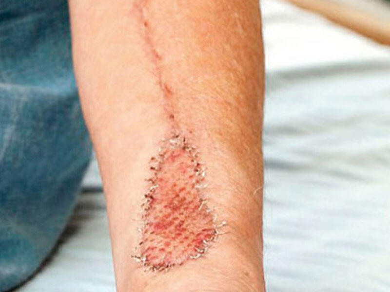 Qolundan dil düzəltdilər