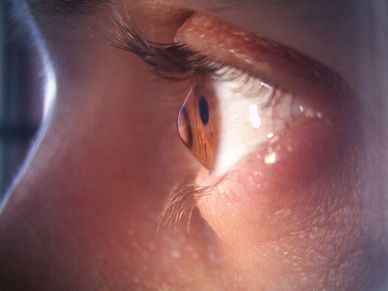 Keratokonus - ağır göz xəstəliyi