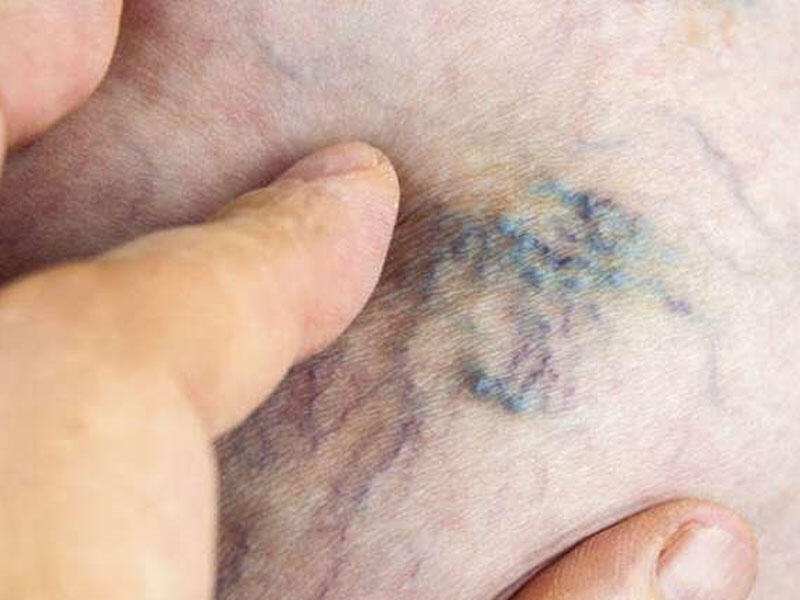 Varikozdan qorunmaq üçün bunları yeyin