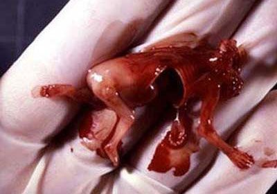 Aborta Allah qarşısında heç bir bəraət yoxdur!!! - FOTOLAR