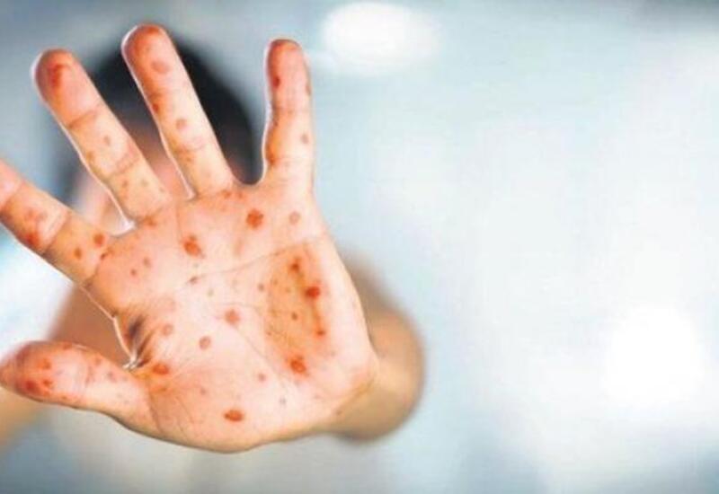 Sankt-Peterburqda iki nəfərdə meymunçiçəyi virusu aşkarlanıb