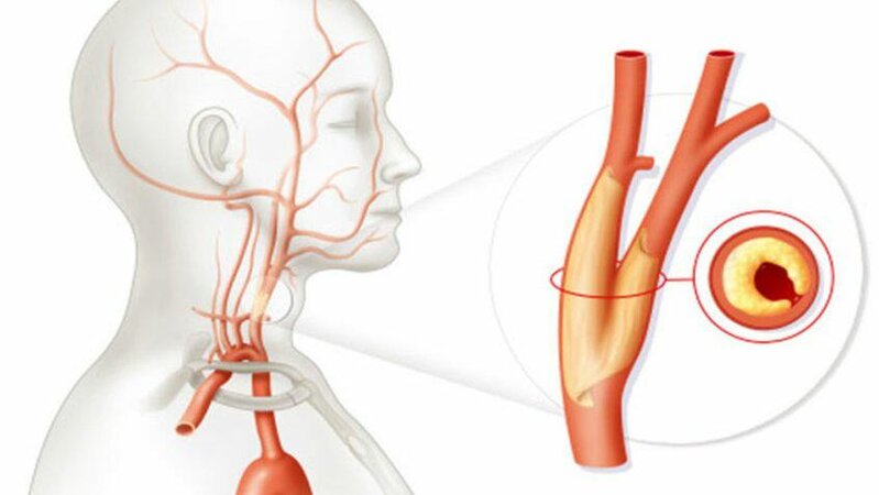 Şah damar tıxanıqlığı nədir?