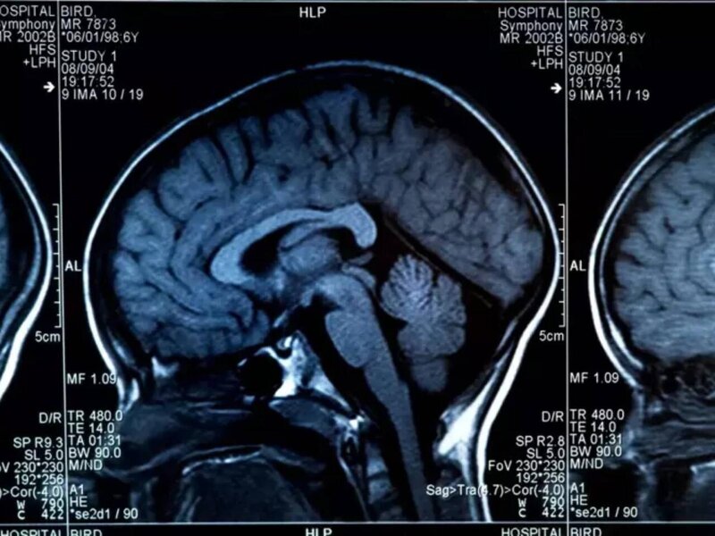 Beyni məhv edən qidalar açıqlandı - Hər gün yeyirik