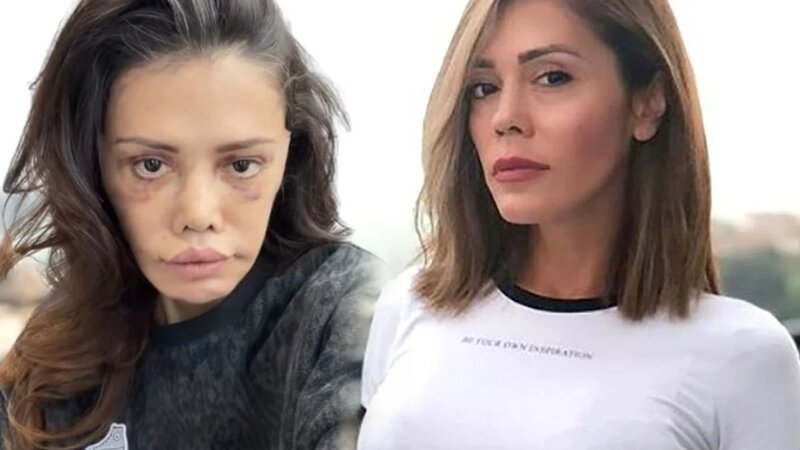 Keçmiş 'Survivor' iştirakçısı üz nəqli etdirdi