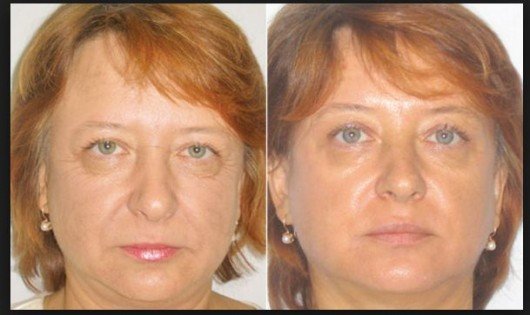 24 saata dəriniz körpə dərisi kimi hamar və yumşaq olacaq