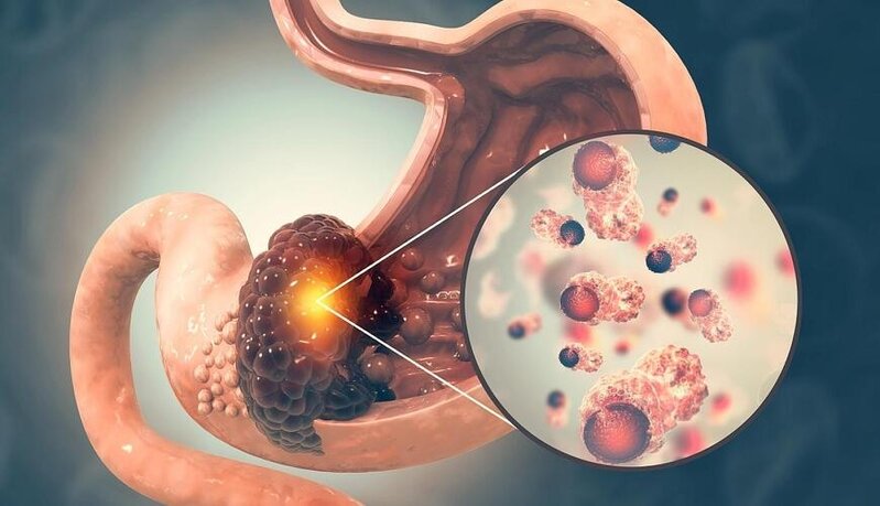 Mədə xərçəngi xəstələrinin 5 ortaq xüsusiyyəti aşkarlandı