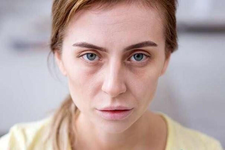 Üzün solğun olması hər zaman qanazlığı demək deyil - Həkim