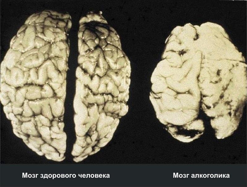 Məşhur professorlar alkoqolun beyinə inanılmaz təsirlərini açıqladı