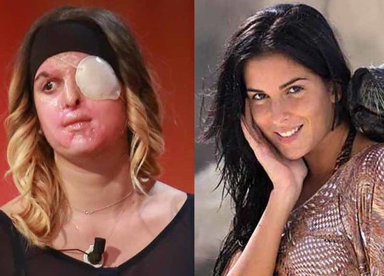 Sevgilisi üzünə asit turşusu tökərək elə bir hala qoydu ki... - DƏHŞƏTLİ FOTOLAR