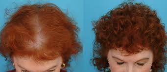 Ən çox axtarışda olan, saç tökülməsinin qarışısını alaraq gur saçlar çıxaran MASKA+ VİDEO