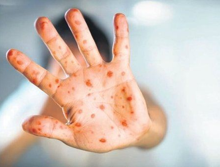 Su çiçəyinə bənzəyən yeni virusu FƏRQLƏNDİRƏN ƏLAMƏT - Yoluxduğunuzu