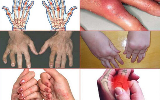 Psoriatik artrit. Simptomlar, diaqnostika, müalicə