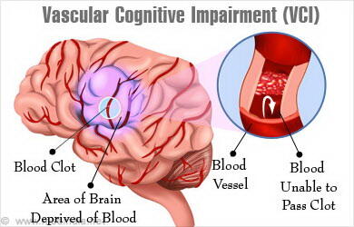 Damar demensiyası nədir? - Həkim yazır